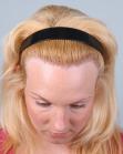 After Hair Transplant&nbsp;Hairline